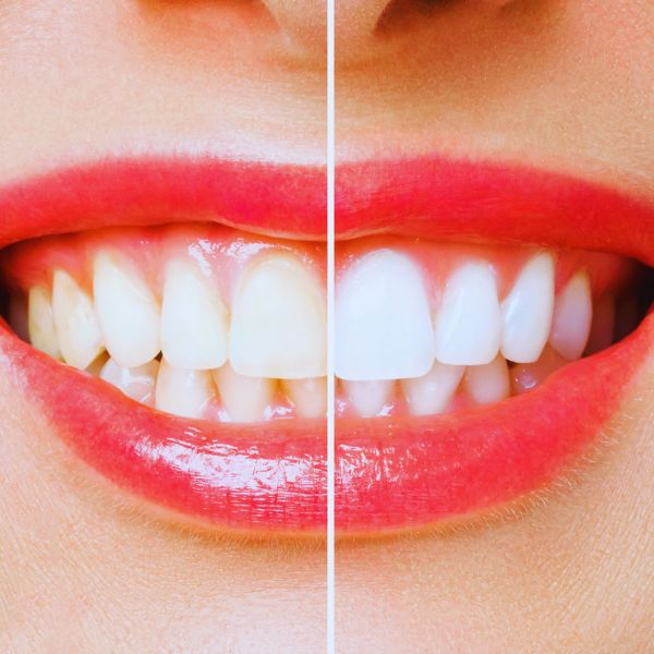 Teeth whitening